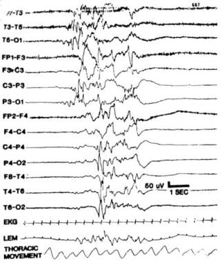 Paroxysmal or burst suppression EEG. Notice promin
