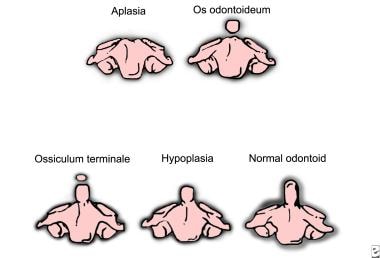 Gradations of odontoid process's appearance. 