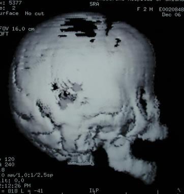 Craniosynostosis management. Lateral view of 3-dim