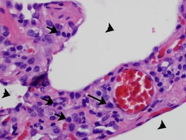 A 46-year-old man with hypersensitivity pneumoniti