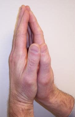 A positive "prayer sign" can be elicited on examin