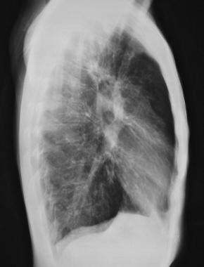 Cystic fibrosis, thoracic. Lateral chest radiograp