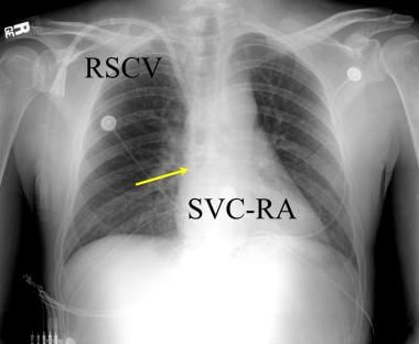 Anteroposterior chest radiograph in a renal transp