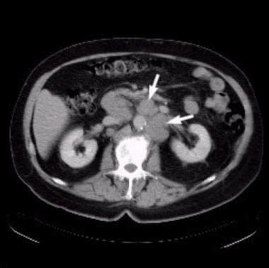 Axial computed tomography (CT) scan at the level o
