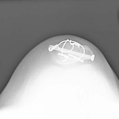 recurrent patella instability icd 10