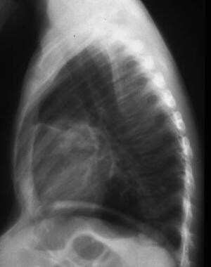 Lateral chest radiograph with mild midline herniat