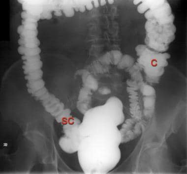 Radiograph of the lower abdomen from a barium enem