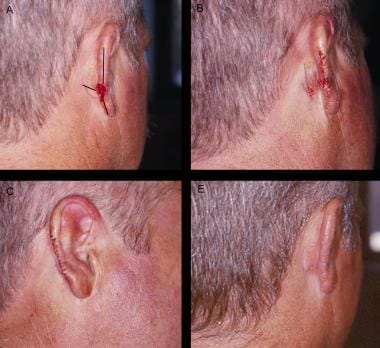 O-to-T advancement flap. Panel A: Defect with inci