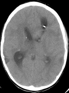 Catheter placed in proximity to lesion, balloon in