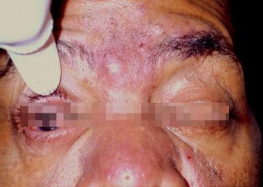 Typical dermatologic findings of rosacea, includin
