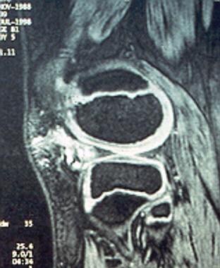 MRI of a pedunculated synovial hemangioma of the k