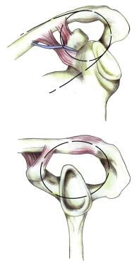 Superior shoulder suspensory complex. (A) anteropo