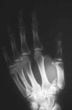 Rolando fracture - There is intra-articular commin