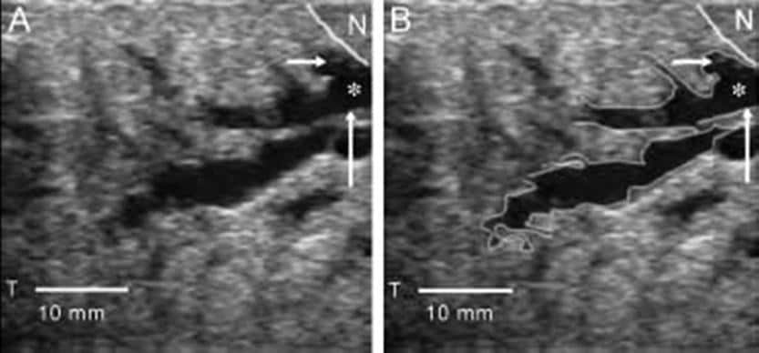 (A) Ultrasound image of milk duct in the lactating