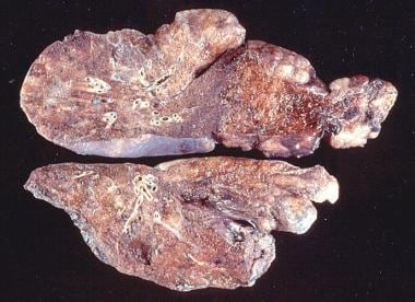 Gross pathology of a patient with emphysema showin