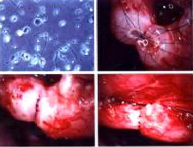 Male infertility. Technique of vasovasostomy: Uppe