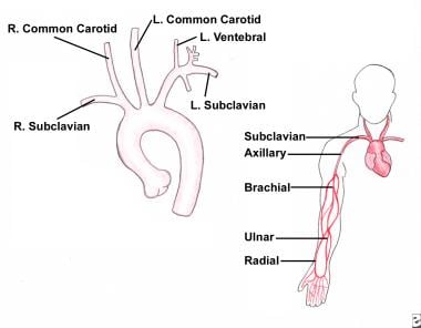 Anatomic drawing of subclavian and brachial arteri