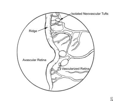 Retinopathy of Prematurity. Stage II retinopathy o