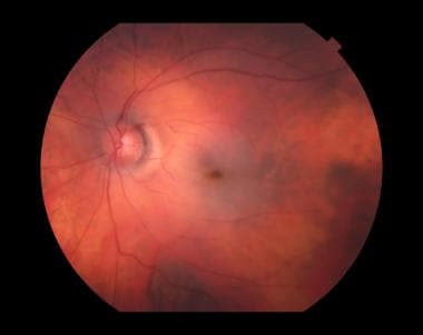 Central retinal artery occlusion (CRAO).