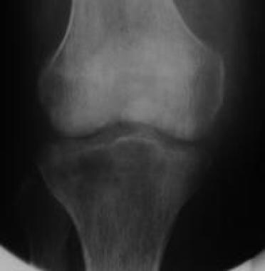 Anteroposterior view of knee demonstrates patchy d