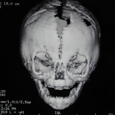 Craniosynostosis management. Frontal view of a 3-d