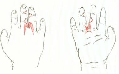 After division of syndactyly, with flaps inset. Sk
