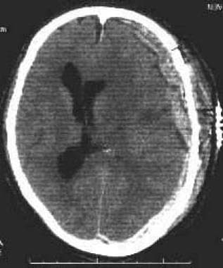 Acute subdural hematoma (SDH) as complication of c