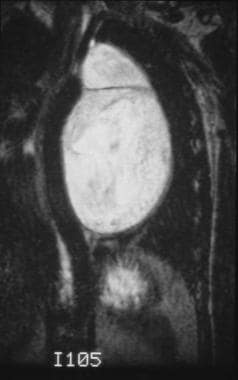 This coronal T2-weighted image demonstrates a well
