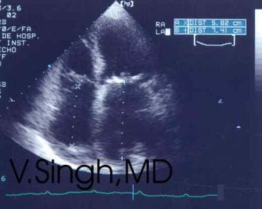 Mitral stenosis as demonstrated with 2-dimensional