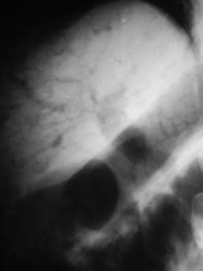 Radiograph in a patient with intestinal ischemia d