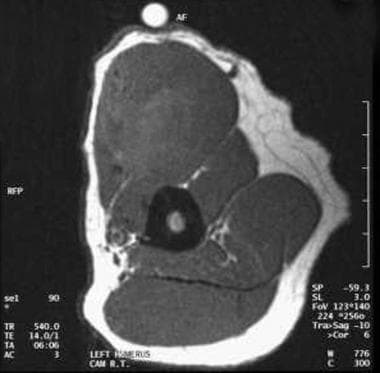 Preinfusion T1-weighted MRI reveals a large mass. 