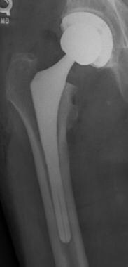 Femoral component position in an initial postopera