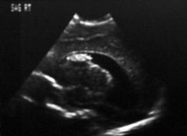 Sagittal neurosonogram. The image demonstrates a g