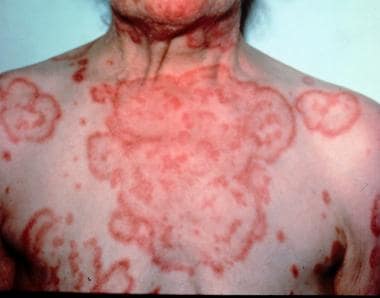 Erythema gyratum repens. The characteristic wood-g