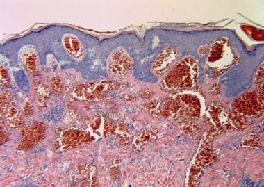 This mid-power histologic view reveals dilated ves