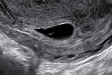 Pregnancy diagnosis. A gestational sac with a yolk