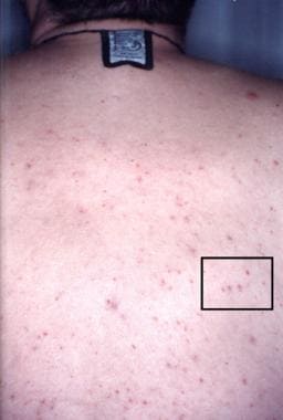 Eruptive xanthomas on the back of a patient admitt