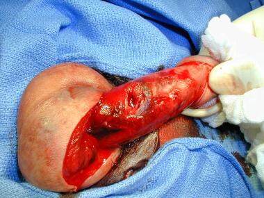 Small penile fracture involving the right corpus c