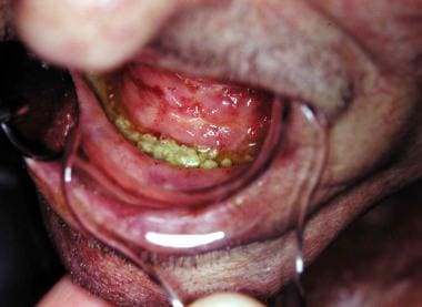 This patient developed ORN following tooth extract