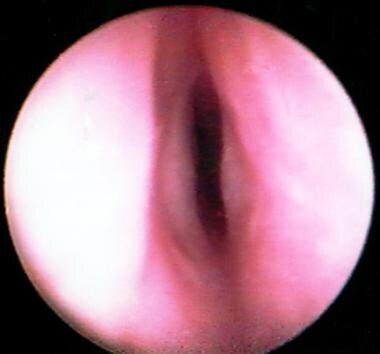 Preoperative endoscopic subglottic view of a 2-yea