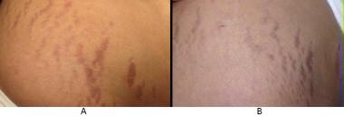 Skin laser treatment for scars