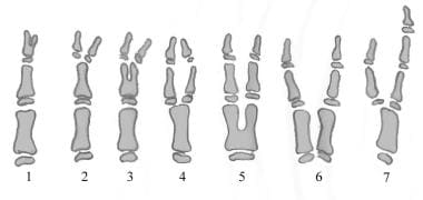 Diagram of Flatt (Wassel) classification of thumb 