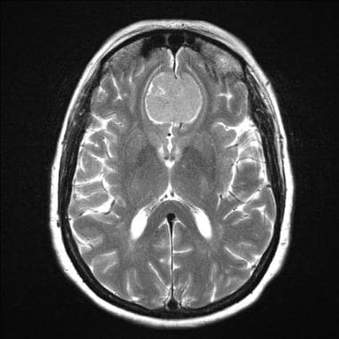 Axial T2 weighted MRI image shows a midline fronta
