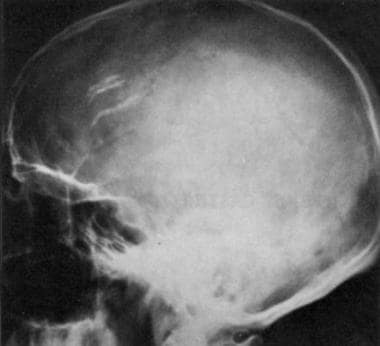 Lateral radiograph of the skull in a 44-year-old m