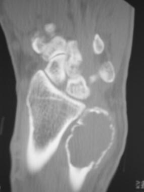 Coronal CT scan of a giant cell tumor of the dista
