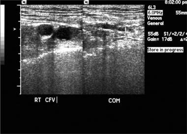 Popliteal vein thrombosis with normal compression 