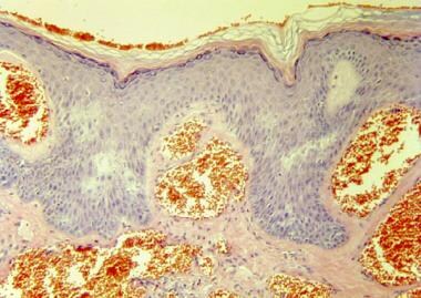 This high-power histologic view reveals some hyper