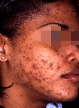 Acne with reactive hyperpigmentation; before treat