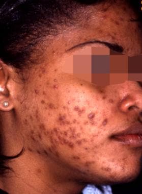 Acne with reactive hyperpigmentation; before treat