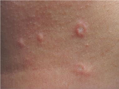 Four papules of Degos disease located on upper-inn